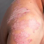 Homeopathic treatment for Psoriasis